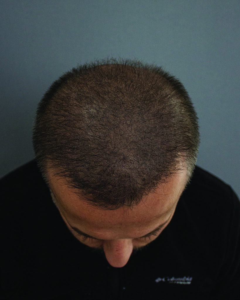 saç simülasyonu, saç dövmesi, saç gölgelendirme, smp, saç simülasyonu öncesi sonrası, saç simülasyonu yaptıranlar