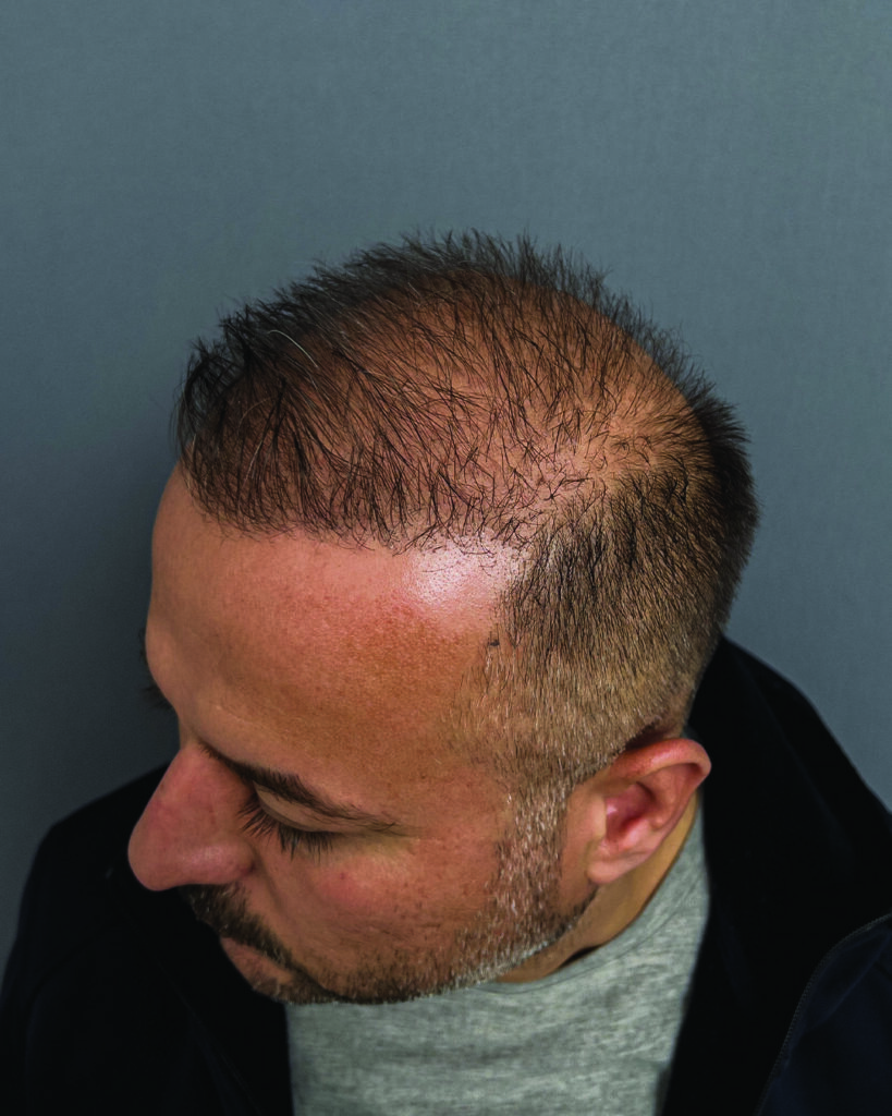 saç simülasyonu, saç dövmesi, saç gölgelendirme, smp, saç simülasyonu öncesi sonrası, saç simülasyonu yaptıranlar