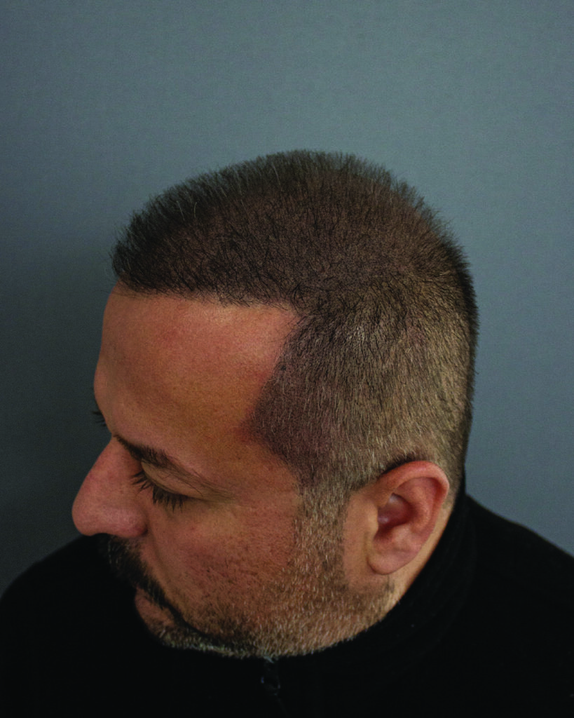 saç simülasyonu, saç dövmesi, saç gölgelendirme, smp, saç simülasyonu öncesi sonrası, saç simülasyonu yaptıranlar