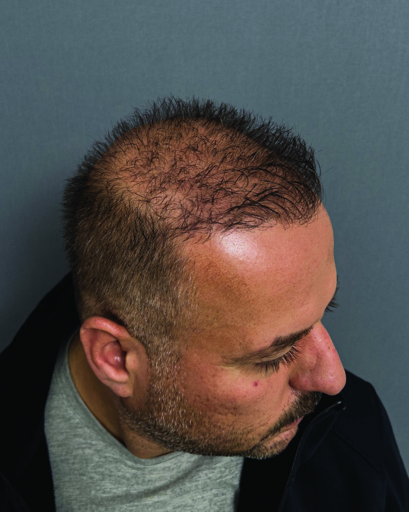 saç simülasyonu, saç dövmesi, saç gölgelendirme, smp, saç simülasyonu öncesi sonrası, saç simülasyonu yaptıranlar