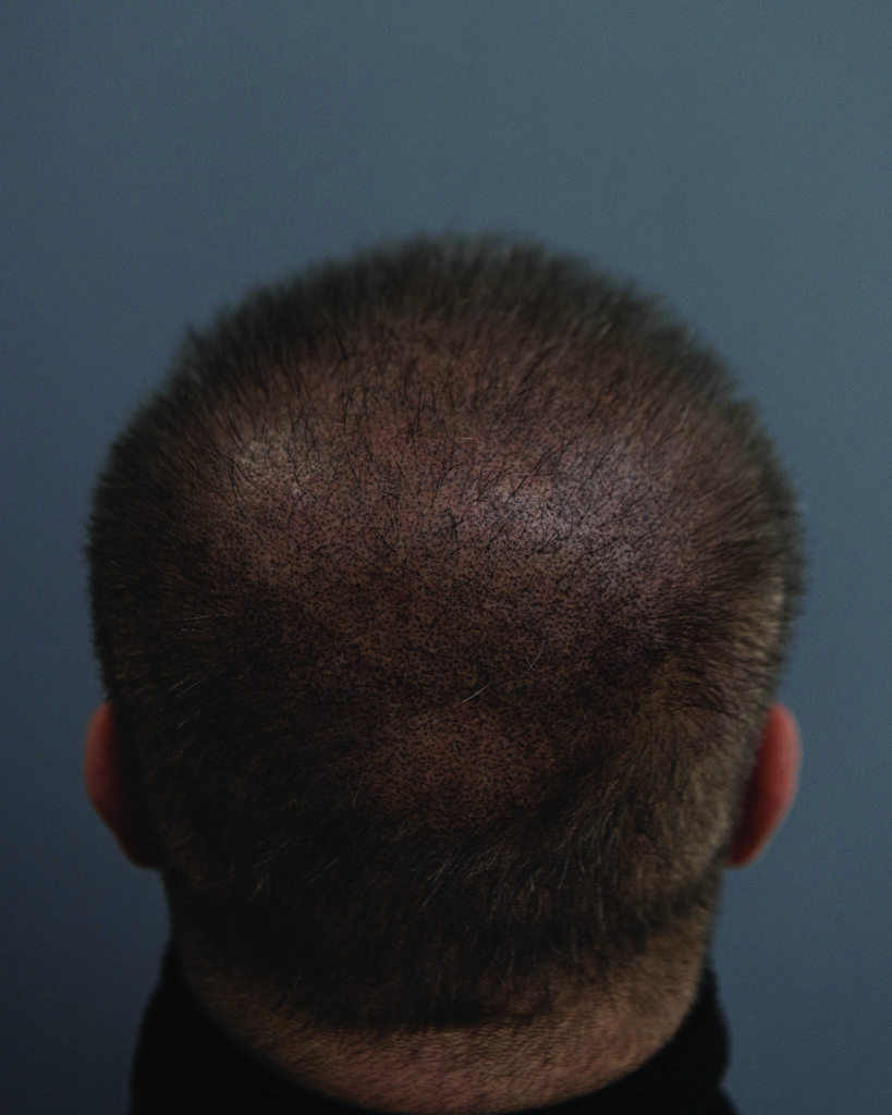 saç simülasyonu, saç dövmesi, saç gölgelendirme, smp, saç simülasyonu öncesi sonrası, saç simülasyonu yaptıranlar