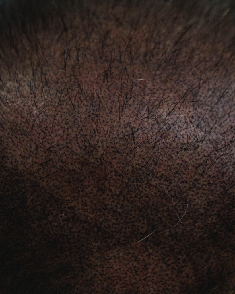 saç simülasyonu, saç dövmesi, saç gölgelendirme, smp, saç simülasyonu öncesi sonrası, saç simülasyonu yaptıranlar