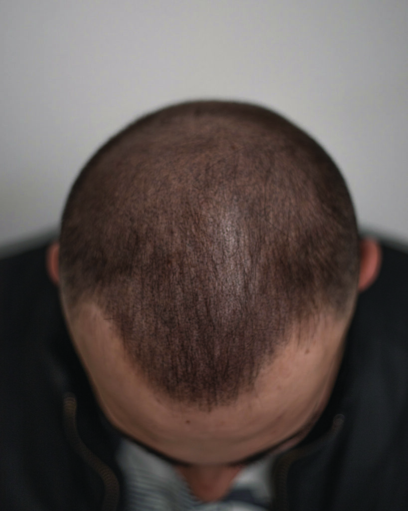 saç simülasyonu, saç dövmesi, saç gölgelendirme, smp, saç simülasyonu öncesi sonrası, saç simülasyonu yaptıranlar