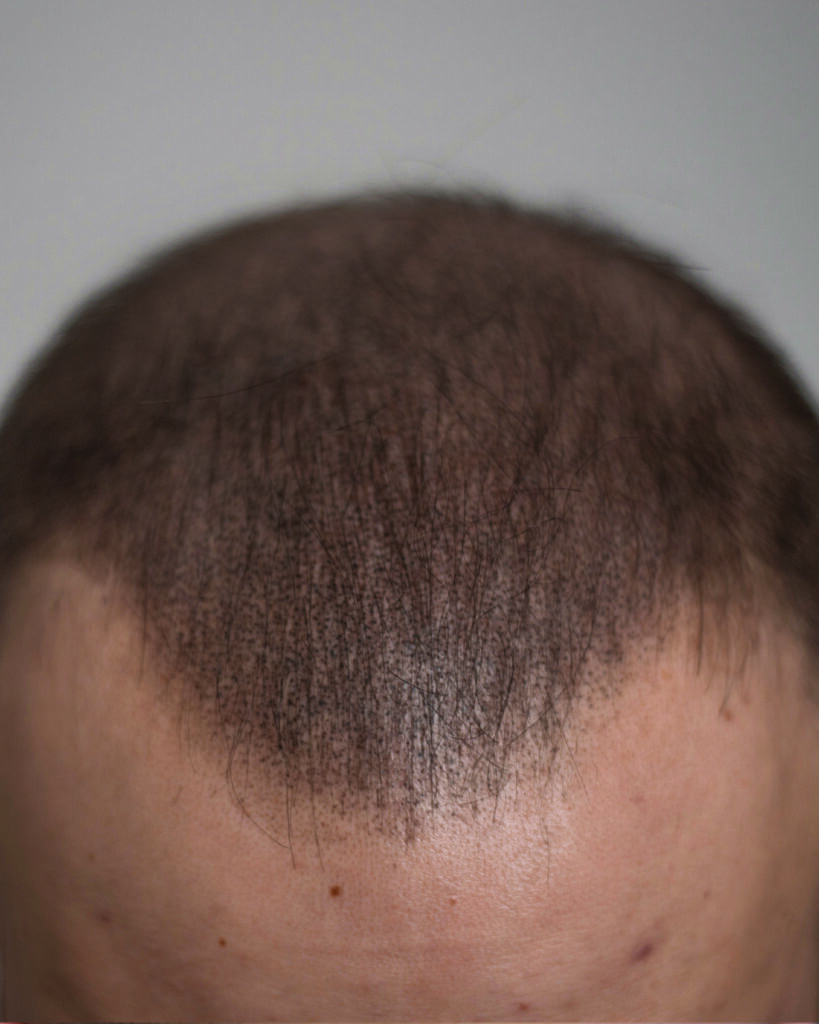 saç simülasyonu, saç dövmesi, saç gölgelendirme, smp, saç simülasyonu öncesi sonrası, saç simülasyonu yaptıranlar