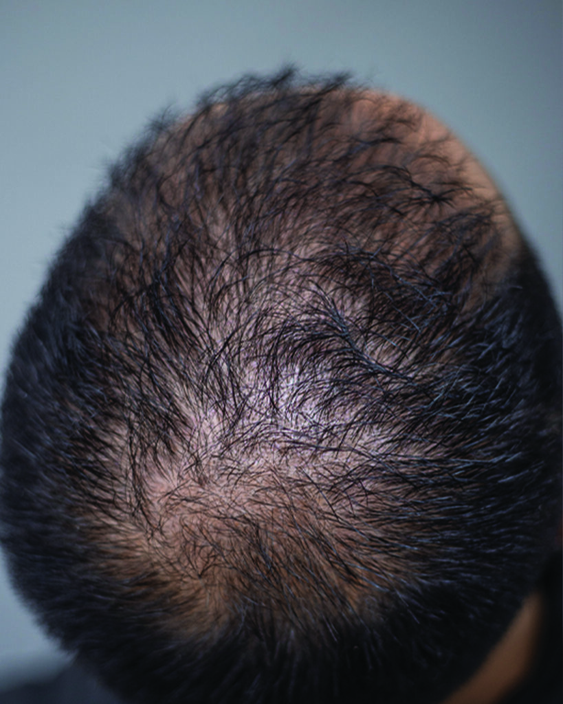 saç simülasyonu, saç dövmesi, saç gölgelendirme, smp, saç simülasyonu öncesi sonrası, saç simülasyonu yaptıranlar