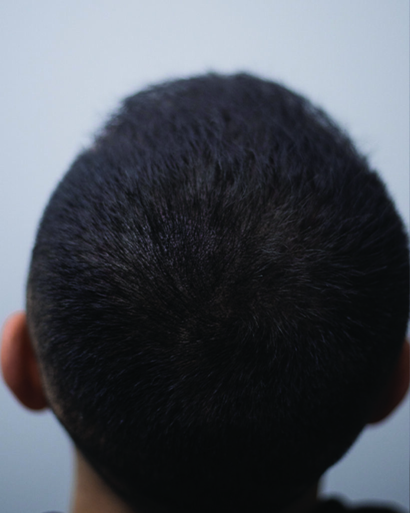 saç simülasyonu, saç dövmesi, saç gölgelendirme, smp, saç simülasyonu öncesi sonrası, saç simülasyonu yaptıranlar