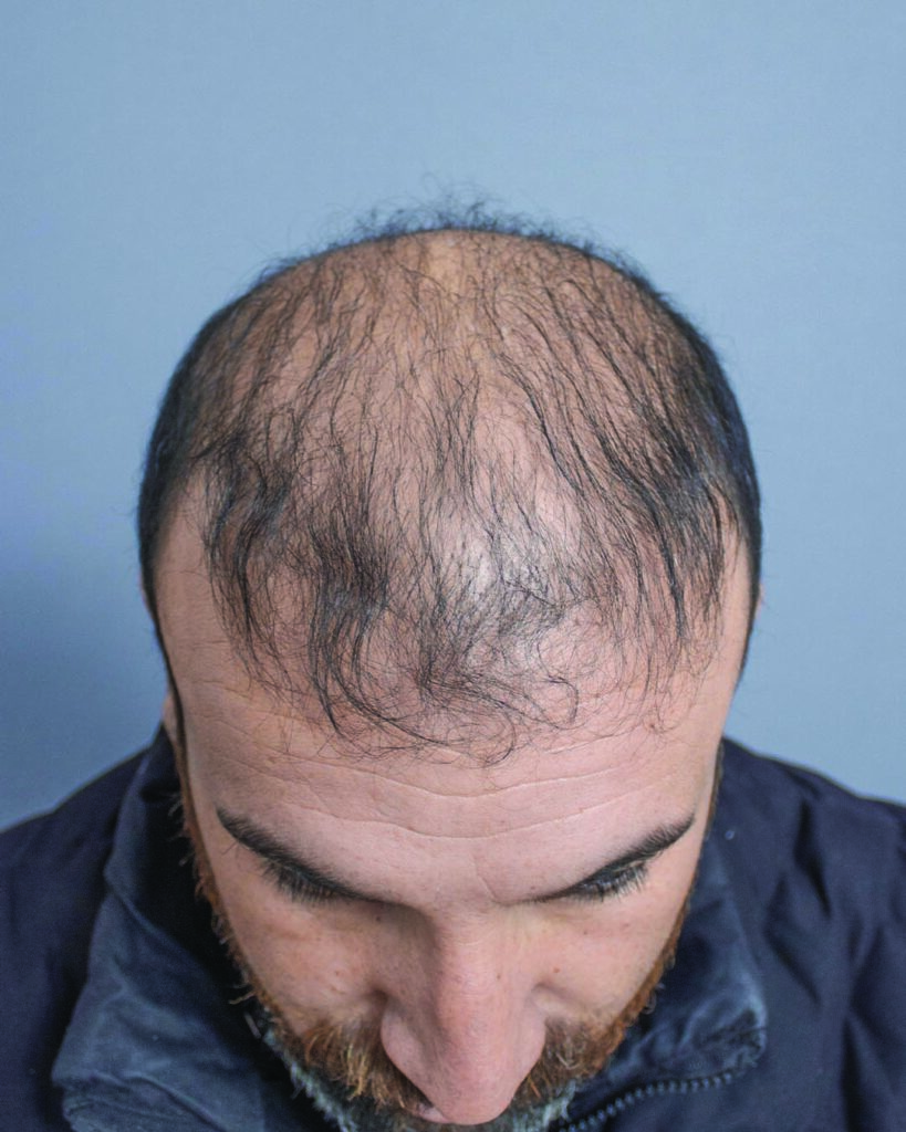 saç simülasyonu, saç dövmesi, saç gölgelendirme, smp, saç simülasyonu öncesi sonrası, saç simülasyonu yaptıranlar