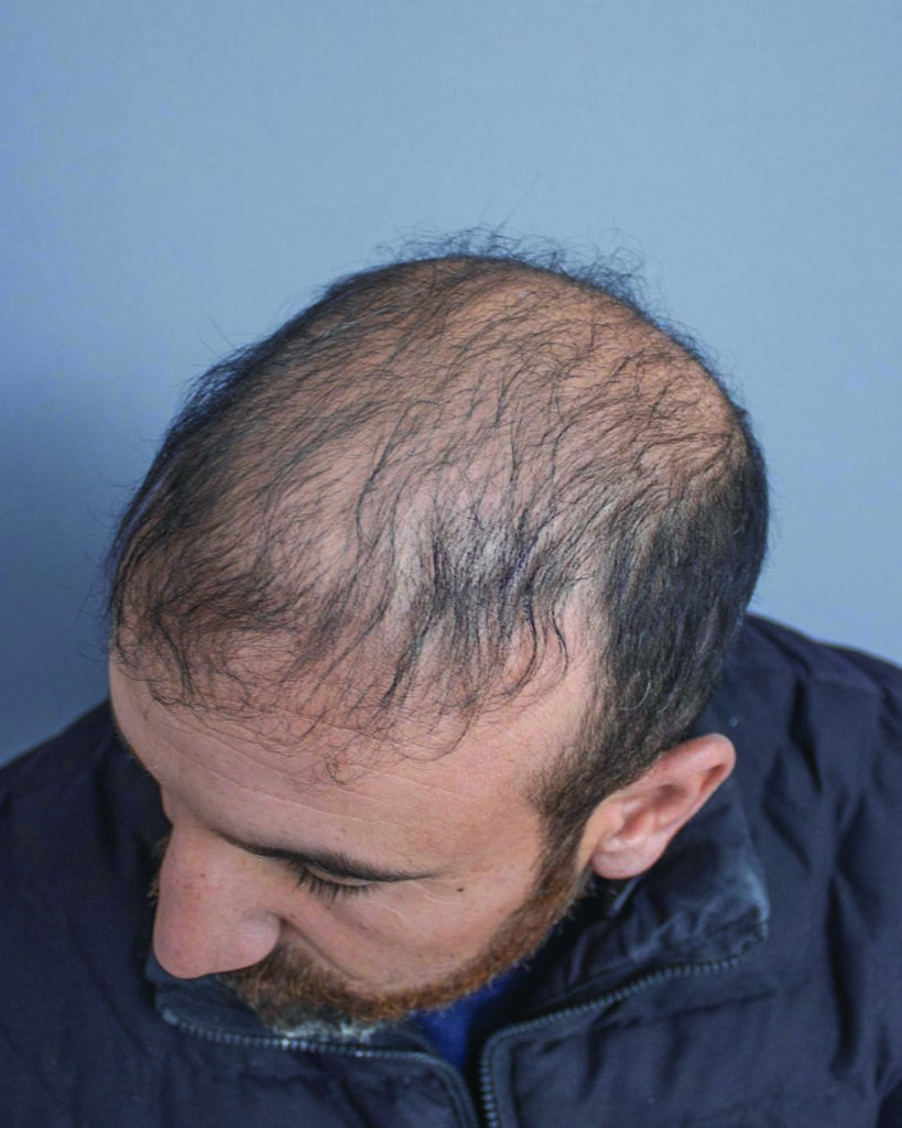 saç simülasyonu, saç dövmesi, saç gölgelendirme, smp, saç simülasyonu öncesi sonrası, saç simülasyonu yaptıranlar