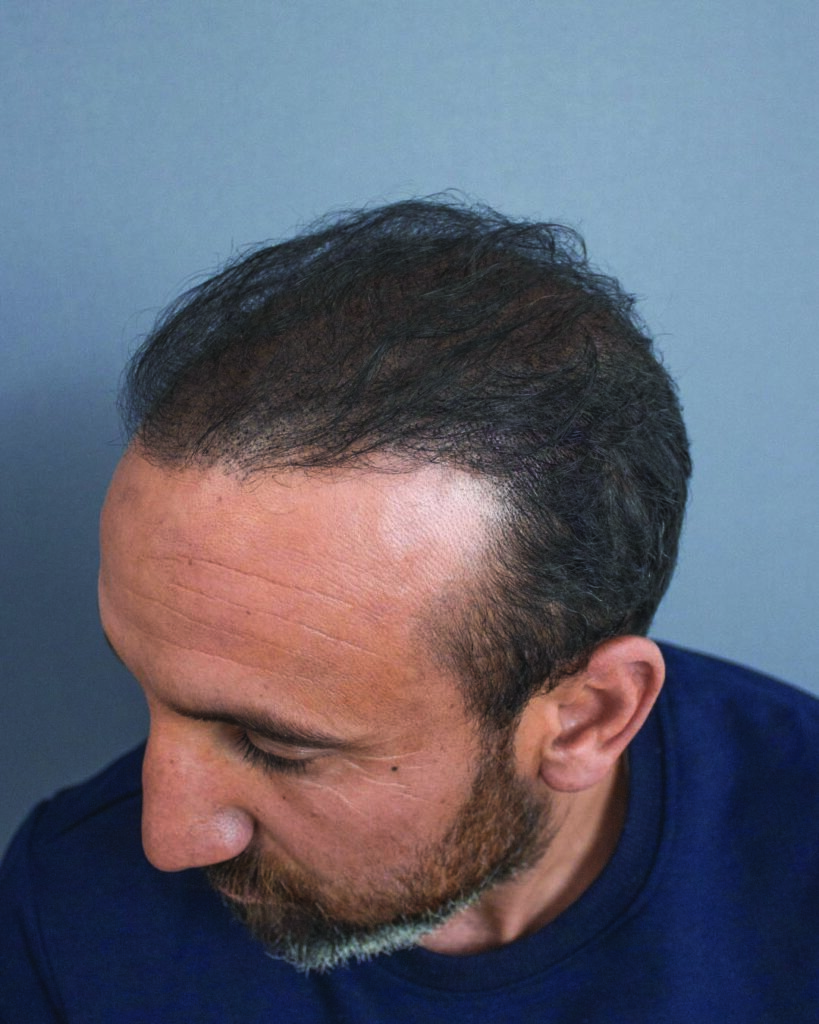 saç simülasyonu, saç dövmesi, saç gölgelendirme, smp, saç simülasyonu öncesi sonrası, saç simülasyonu yaptıranlar