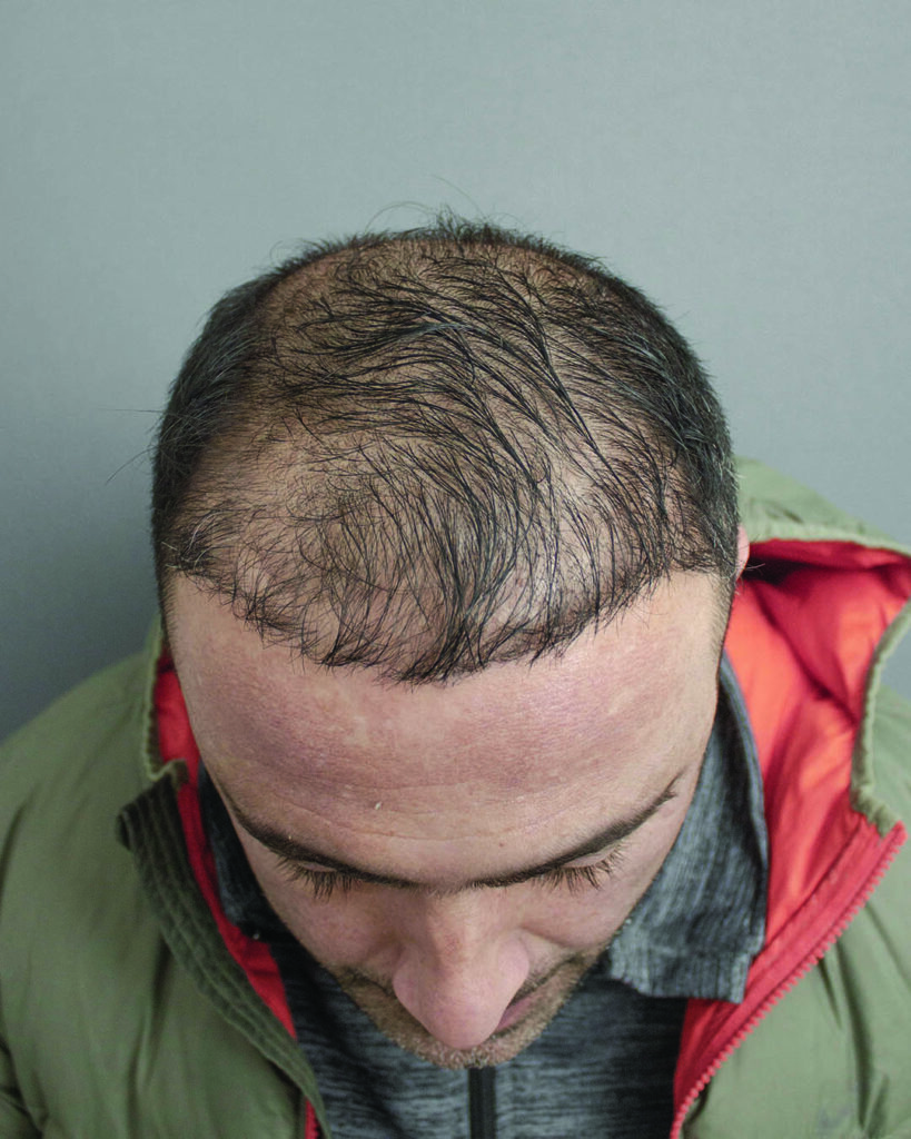 saç simülasyonu, saç dövmesi, saç gölgelendirme, smp, saç simülasyonu öncesi sonrası, saç simülasyonu yaptıranlar