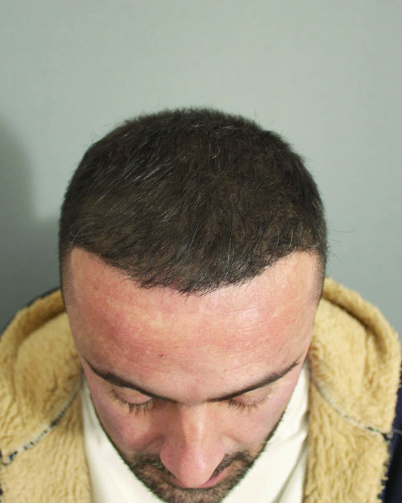 saç simülasyonu, saç dövmesi, saç gölgelendirme, smp, saç simülasyonu öncesi sonrası, saç simülasyonu yaptıranlar