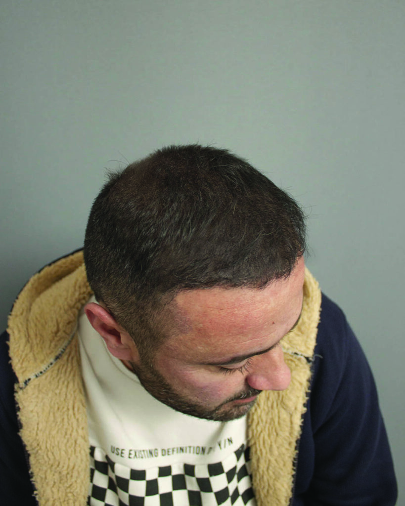 saç simülasyonu, saç dövmesi, saç gölgelendirme, smp, saç simülasyonu öncesi sonrası, saç simülasyonu yaptıranlar