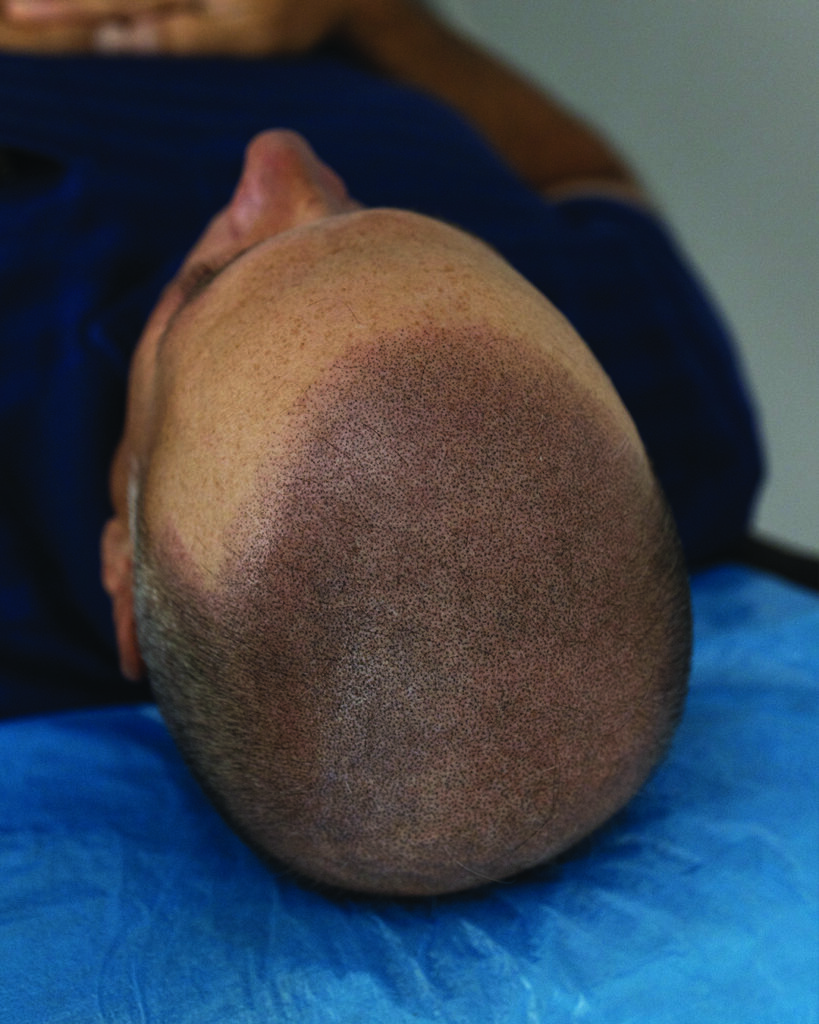 saç simülasyonu, saç dövmesi, saç gölgelendirme, smp, saç simülasyonu öncesi sonrası, saç simülasyonu yaptıranlar