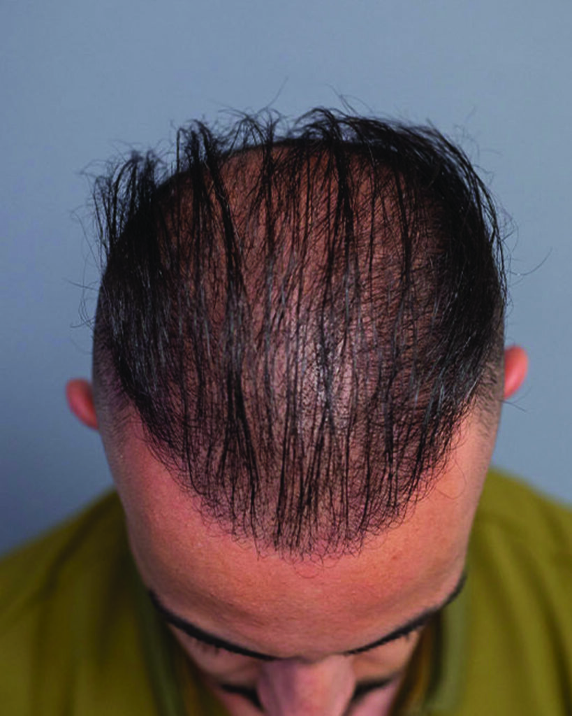 saç simülasyonu, saç dövmesi, saç gölgelendirme, smp, saç simülasyonu öncesi sonrası, saç simülasyonu yaptıranlar