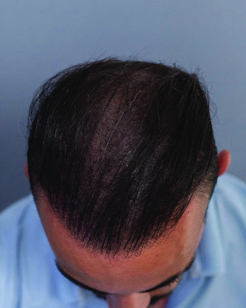 saç simülasyonu, saç dövmesi, saç gölgelendirme, smp, saç simülasyonu öncesi sonrası, saç simülasyonu yaptıranlar