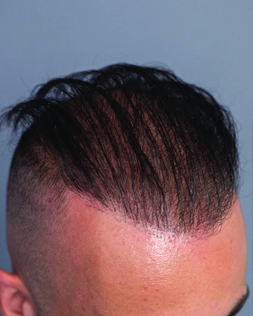 saç simülasyonu, saç dövmesi, saç gölgelendirme, smp, saç simülasyonu öncesi sonrası, saç simülasyonu yaptıranlar