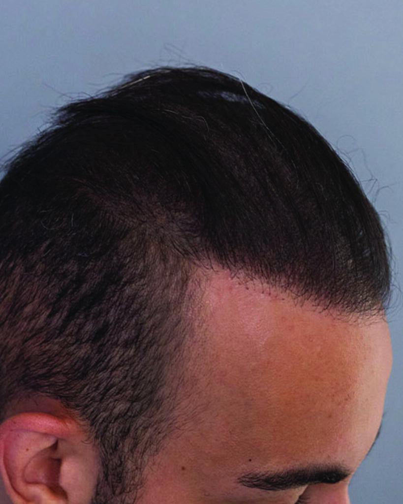 saç simülasyonu, saç dövmesi, saç gölgelendirme, smp, saç simülasyonu öncesi sonrası, saç simülasyonu yaptıranlar