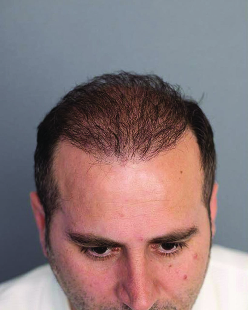 saç simülasyonu, saç dövmesi, saç gölgelendirme, smp, saç simülasyonu öncesi sonrası, saç simülasyonu yaptıranlar