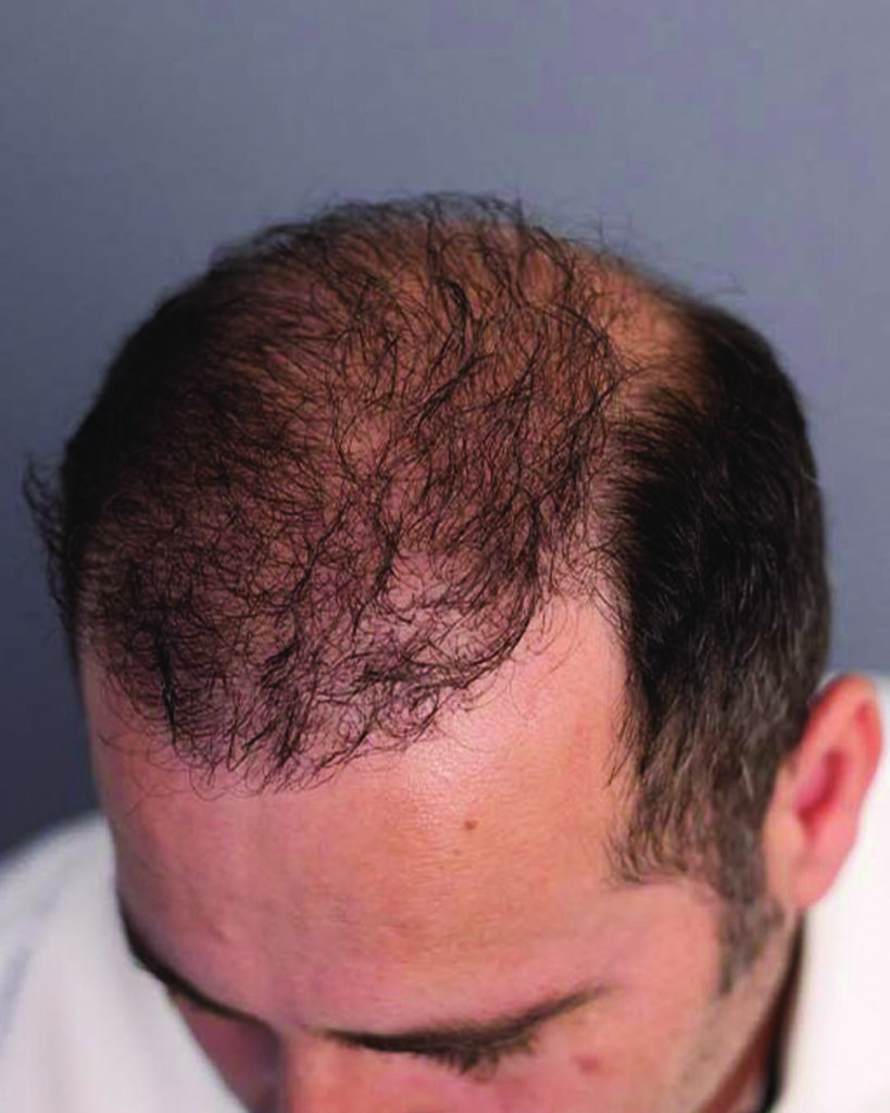 saç simülasyonu, saç dövmesi, saç gölgelendirme, smp, saç simülasyonu öncesi sonrası, saç simülasyonu yaptıranlar