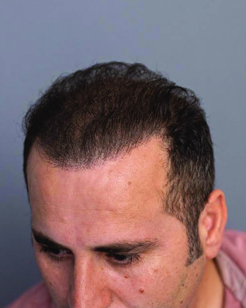 saç simülasyonu, saç dövmesi, saç gölgelendirme, smp, saç simülasyonu öncesi sonrası, saç simülasyonu yaptıranlar