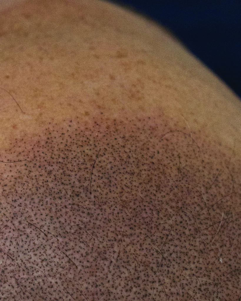 saç simülasyonu, saç dövmesi, saç gölgelendirme, smp, saç simülasyonu öncesi sonrası, saç simülasyonu yaptıranlar