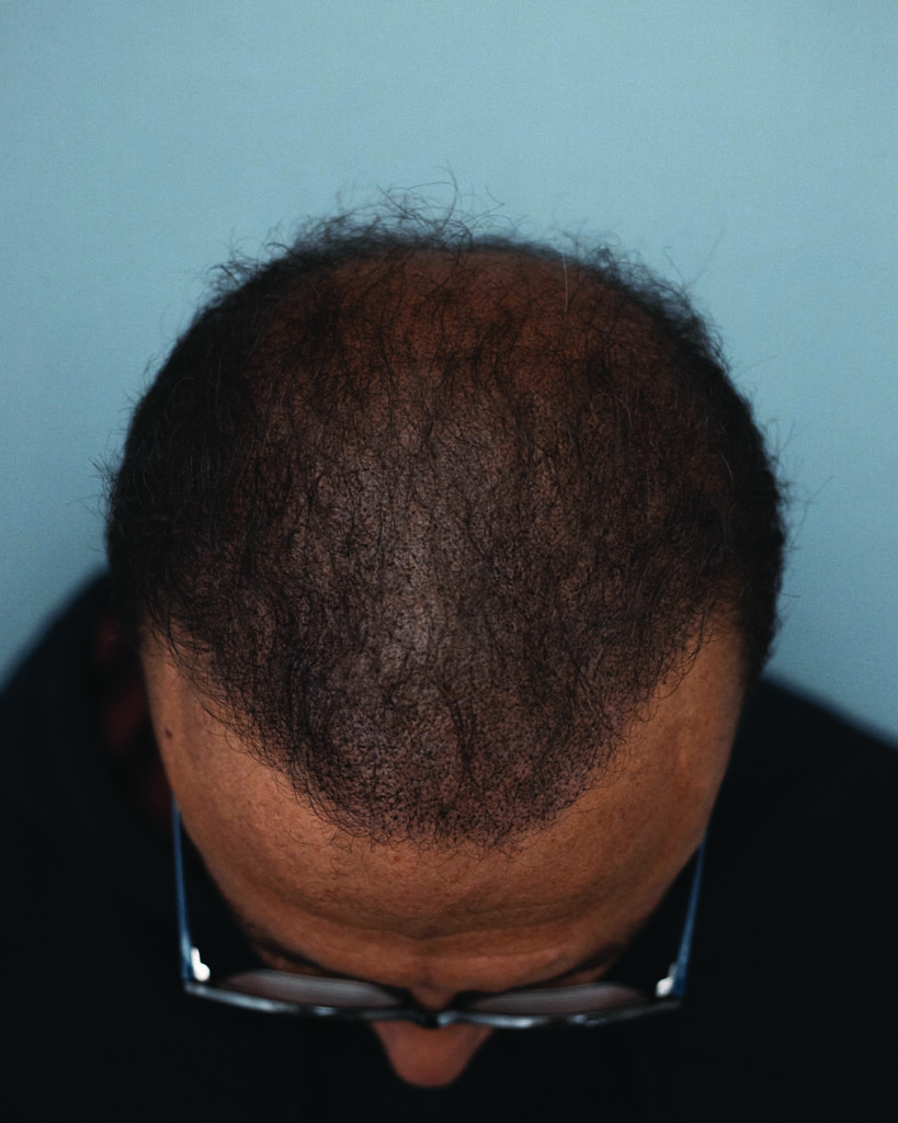 saç simülasyonu, saç dövmesi, saç gölgelendirme, smp, saç simülasyonu öncesi sonrası, saç simülasyonu yaptıranlar