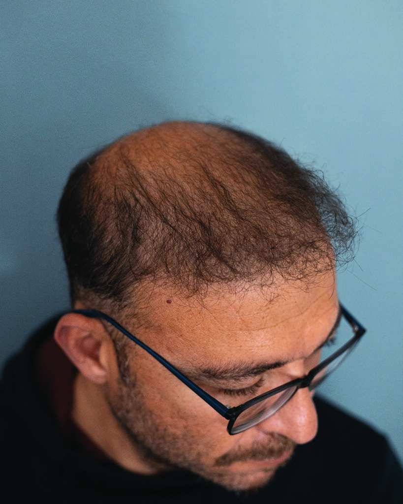 saç simülasyonu, saç dövmesi, saç gölgelendirme, smp, saç simülasyonu öncesi sonrası, saç simülasyonu yaptıranlar