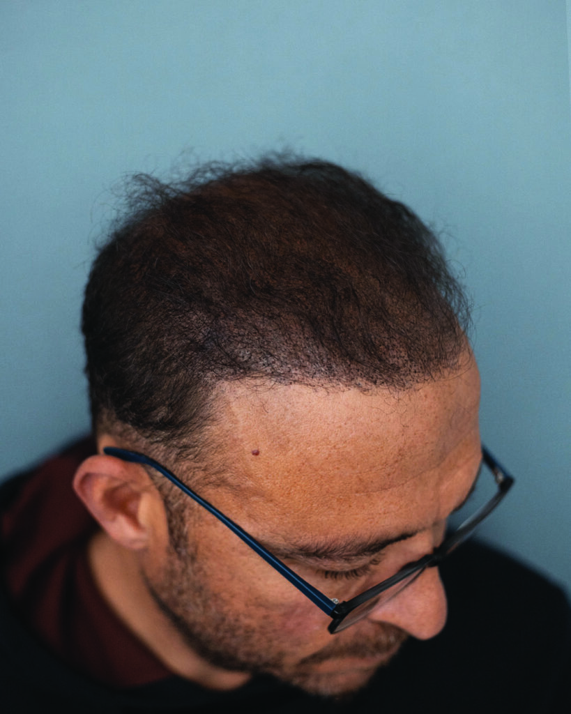 saç simülasyonu, saç dövmesi, saç gölgelendirme, smp, saç simülasyonu öncesi sonrası, saç simülasyonu yaptıranlar