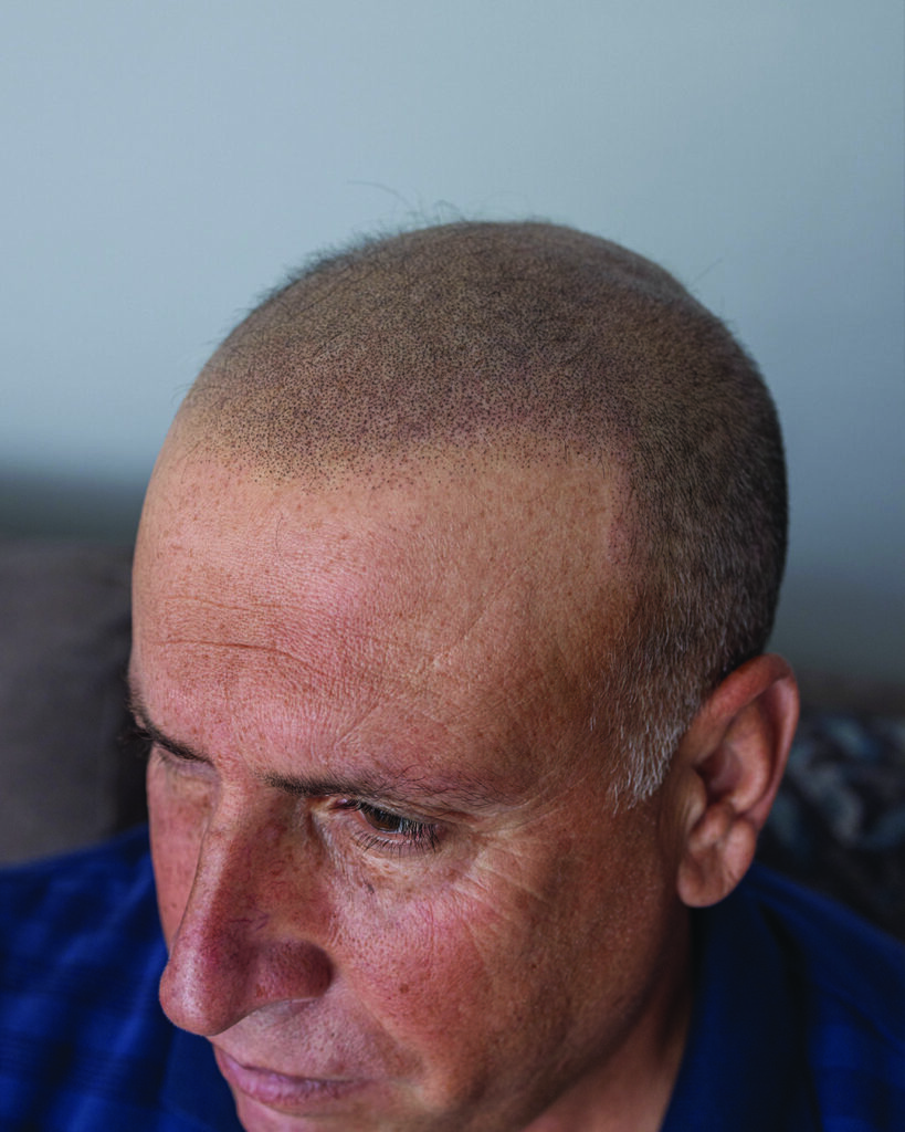 saç simülasyonu, saç dövmesi, saç gölgelendirme, smp, saç simülasyonu öncesi sonrası, saç simülasyonu yaptıranlar