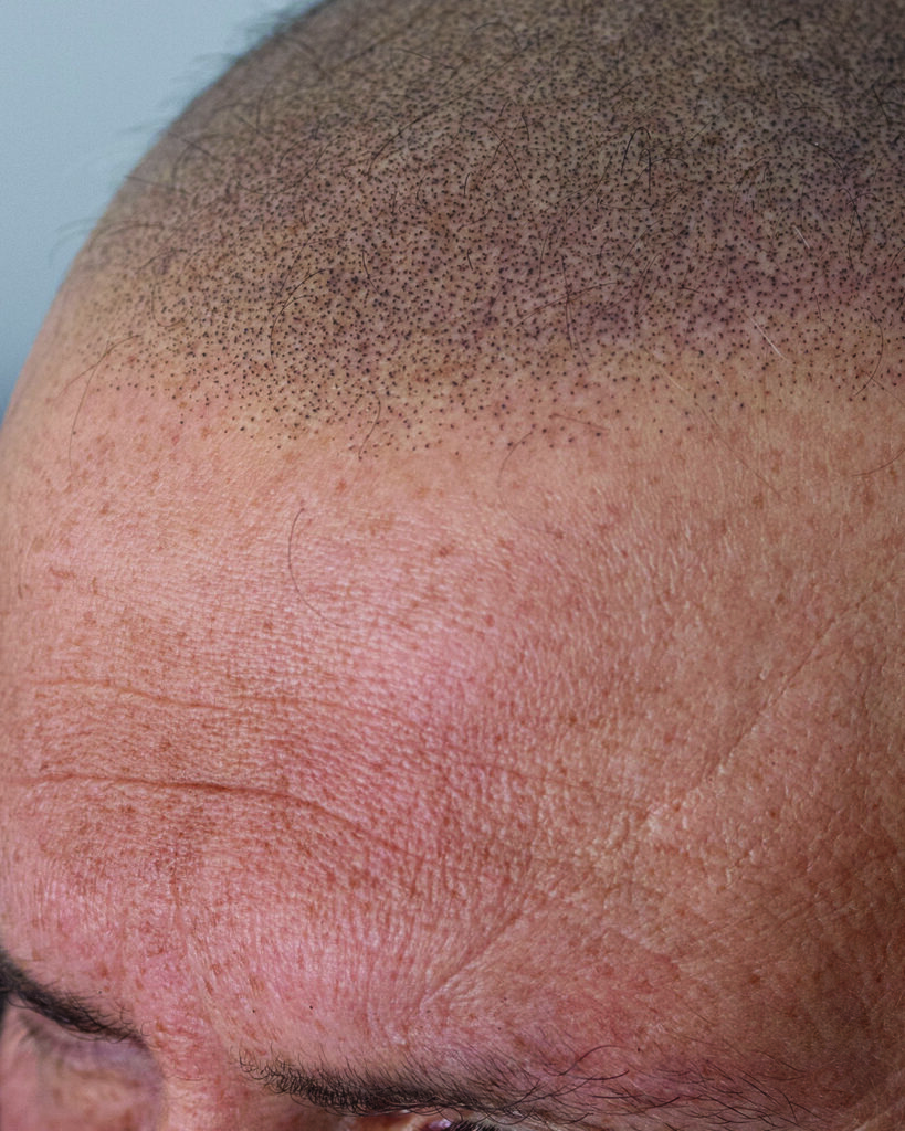 saç simülasyonu, saç dövmesi, saç gölgelendirme, smp, saç simülasyonu öncesi sonrası, saç simülasyonu yaptıranlar