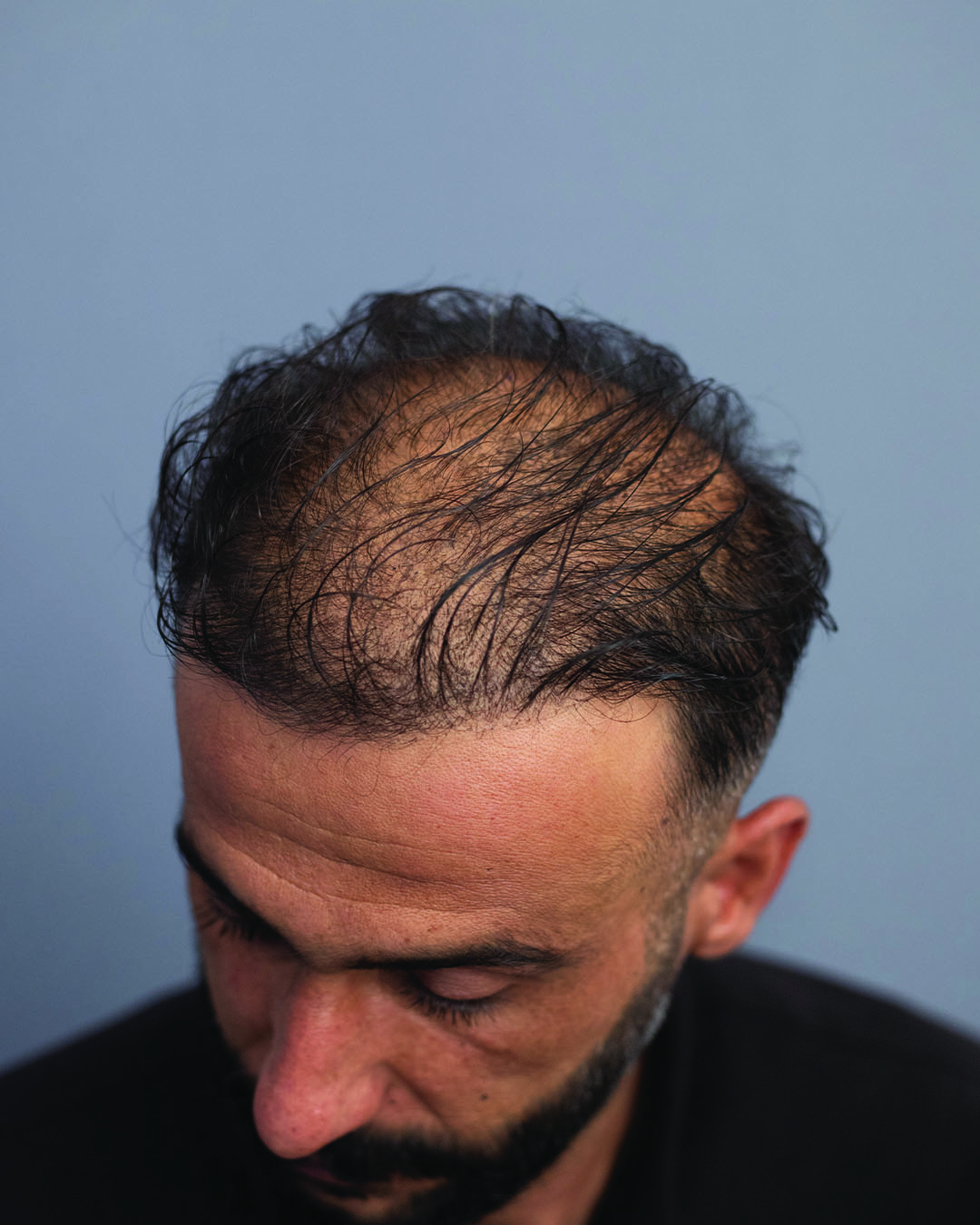 Semih Deniz’in saç simülasyonu uygulama örneği — görünüm 1