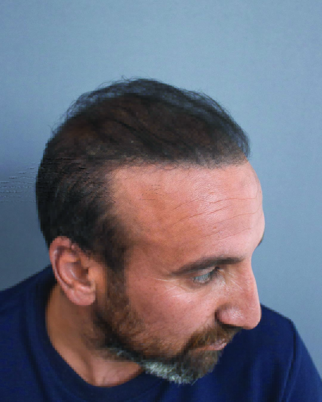 Semih Deniz’in saç simülasyonu uygulama örneği — görünüm 2