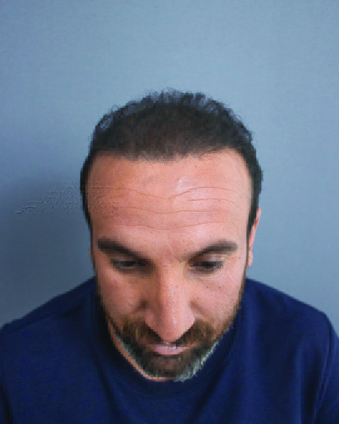 Semih Deniz’in saç simülasyonu uygulama örneği — görünüm 2