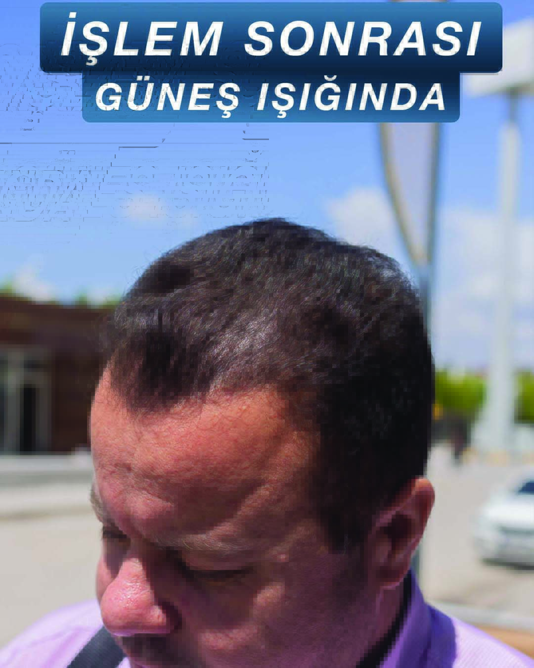 Semih Deniz’in saç simülasyonu uygulama örneği — görünüm 2